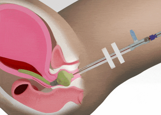 Animation of Device Inserted Into Uterus to Control Abnormal Postpartum Hemorrhage