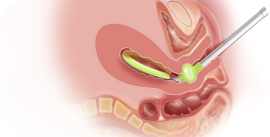 Diagram of the JADA® System Device Inserted Into Uterus to Induce Contractions